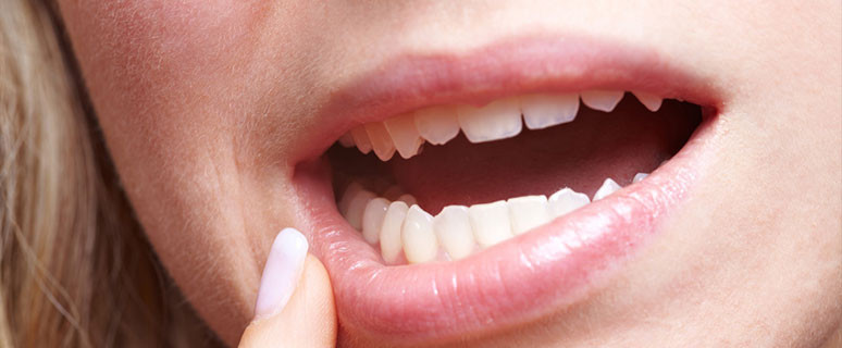 Periodontitis Puts Heart and Teeth at Risk. Parodontitis